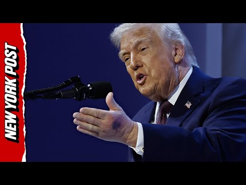 Trump Reveals Reason Behind Huge Bruise On His Hand